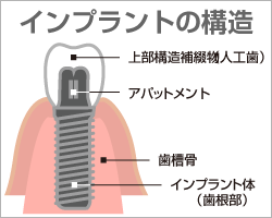 インプラントの構造