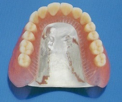 コバルトクロム合金鋳造床義歯