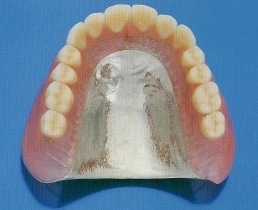 純チタン鋳造床義歯